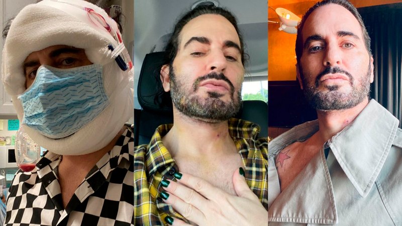 Marc Jacobs o operacjach plastycznych